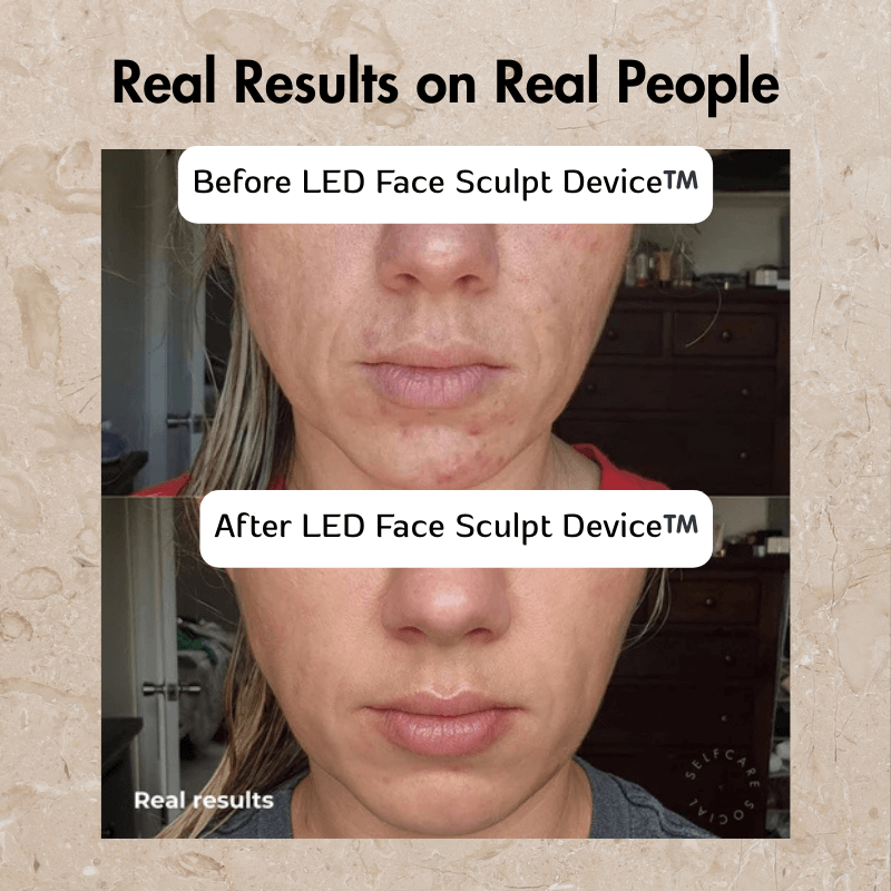 IrisSkin™️ LED Face Sculpt Device