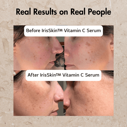 IrisSkin™️ Vitamin C Serum